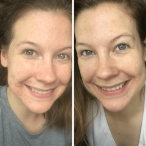skin care before and after