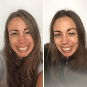 skin care before and after